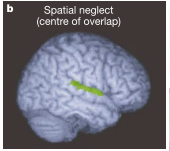 半側空間無視の本当の責任領域はどこなのか？