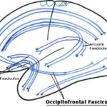 半側空間無視の予後を決めるものは何か?