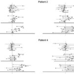 線分二等分試験における患者の視線の動きから何が分かるのか？